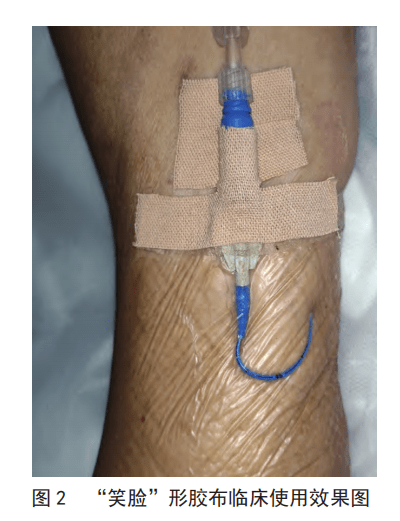 降低picc 脱管率,"笑脸"形胶布导管外固定法了解一下~_护理_进行_来福