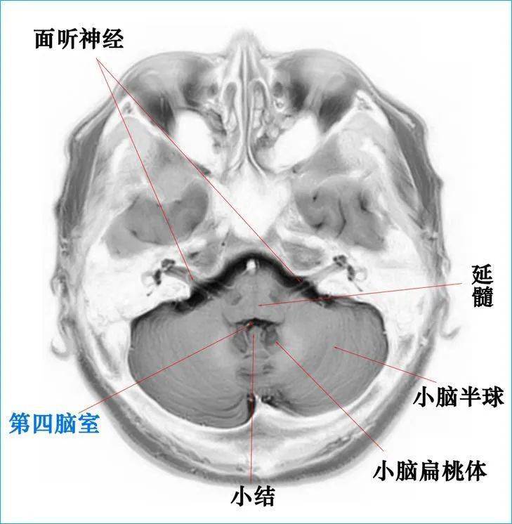 核磁头颅解剖图图片