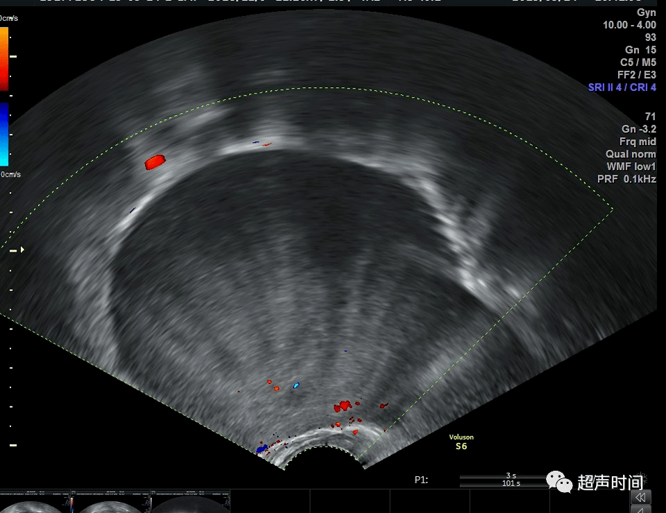 卵巢纤维瘤超声图片图片
