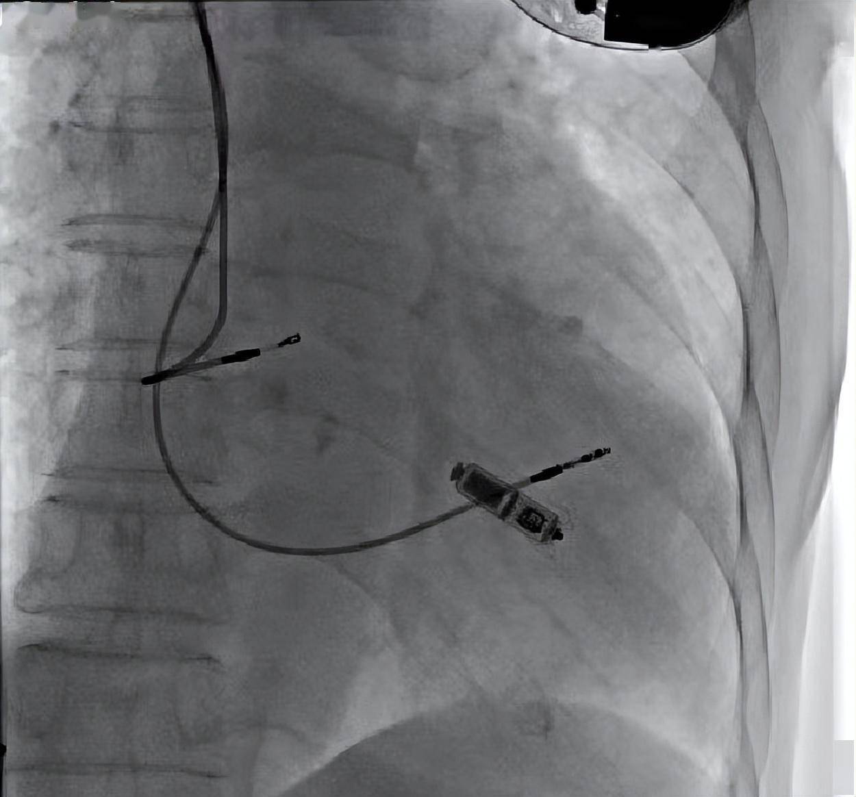 心脏起搏器安装后图片图片