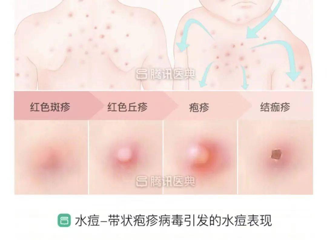 斑疹(扁平红点),丘疹(小红痘),疱疹(晶莹剔透的小水疱),结痂(水疱破溃