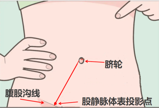 垂直静脉图片