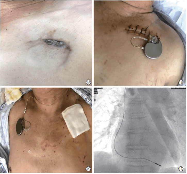 心脏起搏器伤口图片图片