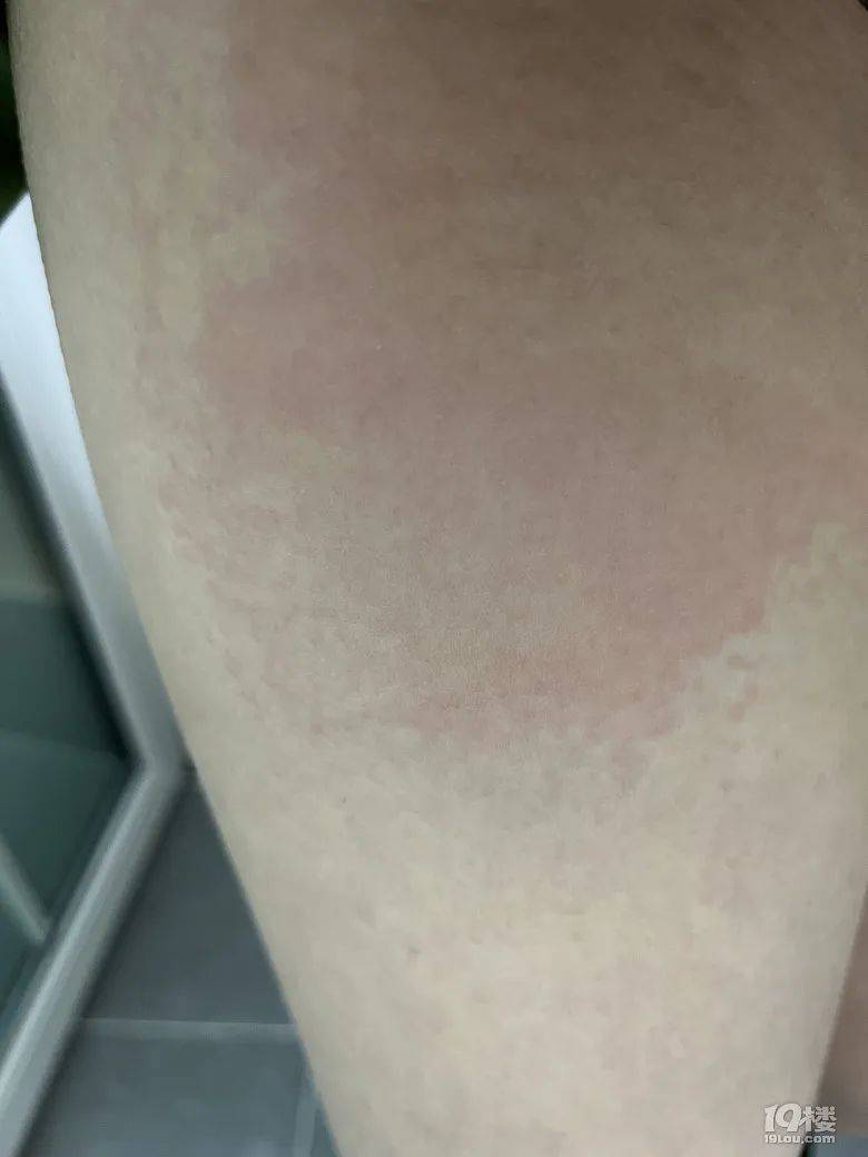 春天又过敏了怎么办?_过敏性_过敏原_疾病