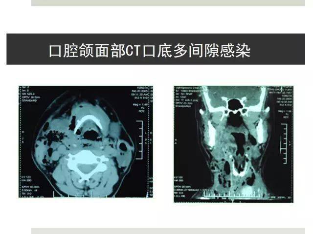 口腔頜面部間隙感染[多圖]_平臺_科普網_尋找