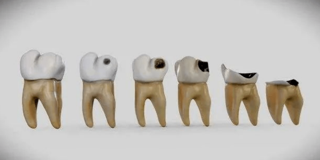 牙齿残根残冠还能保留吗?