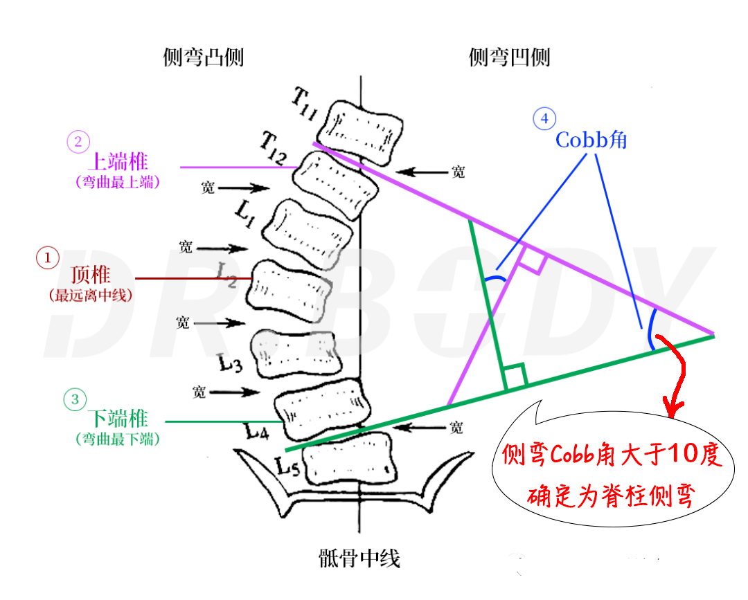 脊柱后凸度数对照表图片