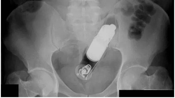 阴道里塞手枪算啥,我还见过更奇葩的!_赵医生_异物_黄瓜