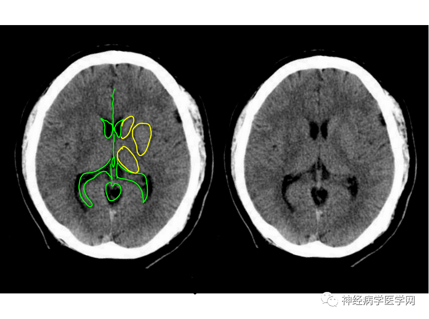 颅脑疾病 ct,mri 影像特异征象(徐桂兴博士精品)_医学_来源
