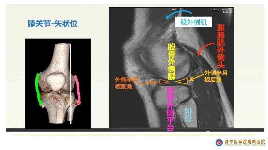 膝关节正常ct解剖图图片