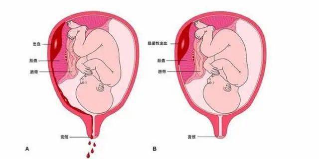 胎盘位于宫底图片图片