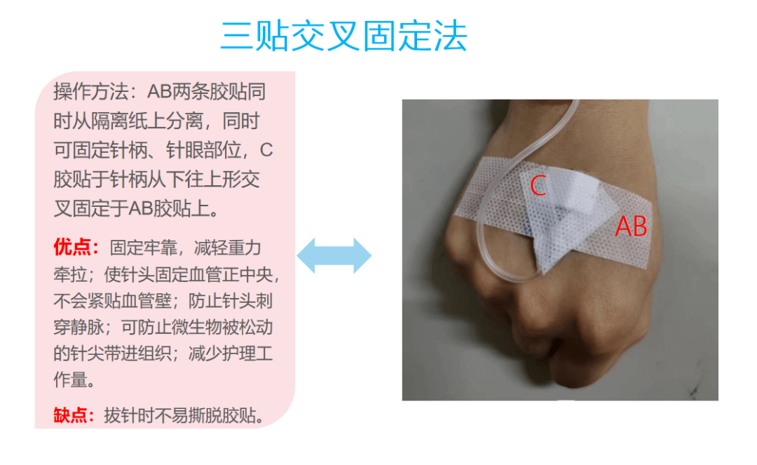 《医用输液贴"v"形固定法与平行固定法的静脉输液效果比较 》2