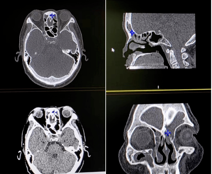 鼻窦ct检查除此鼻内镜和ct之外,医生还会根据患者情况,安排鼻窦糯 