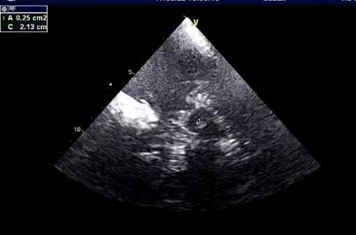 早期诊断帕金森,黑质超声来帮您_检查_患者_回声