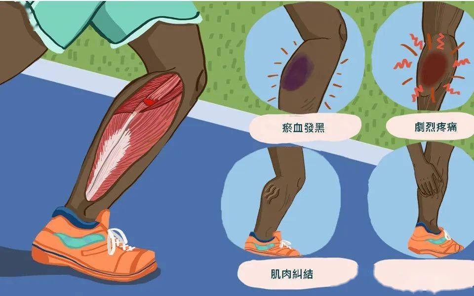 3种贴扎法治疗网球腿疼痛