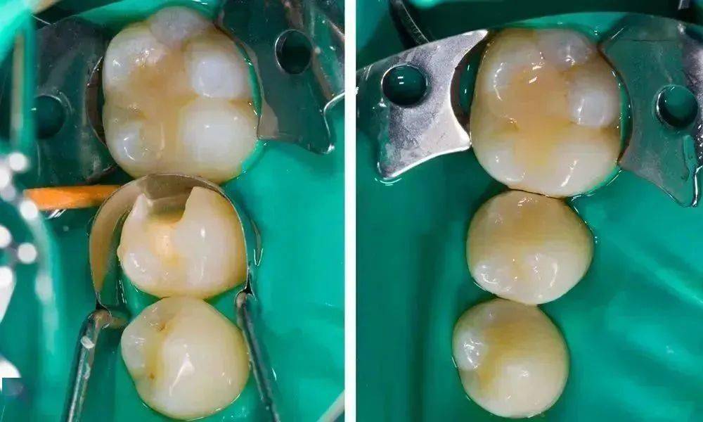 整个补牙过程一气呵成,一颗形态完整的牙齿如浑然天成般再次呈