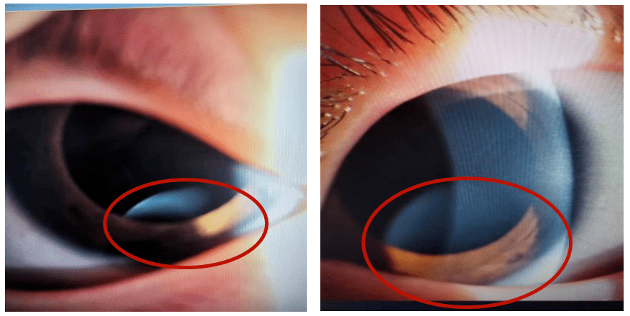 原来是马凡综合征_手术_患儿_安安才