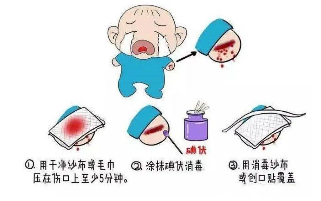 意外创伤当出现意外创伤时,应立即用干净的纱布按压伤口止血,止血后用