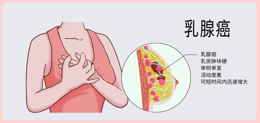 做好这几件事，远离乳腺癌
