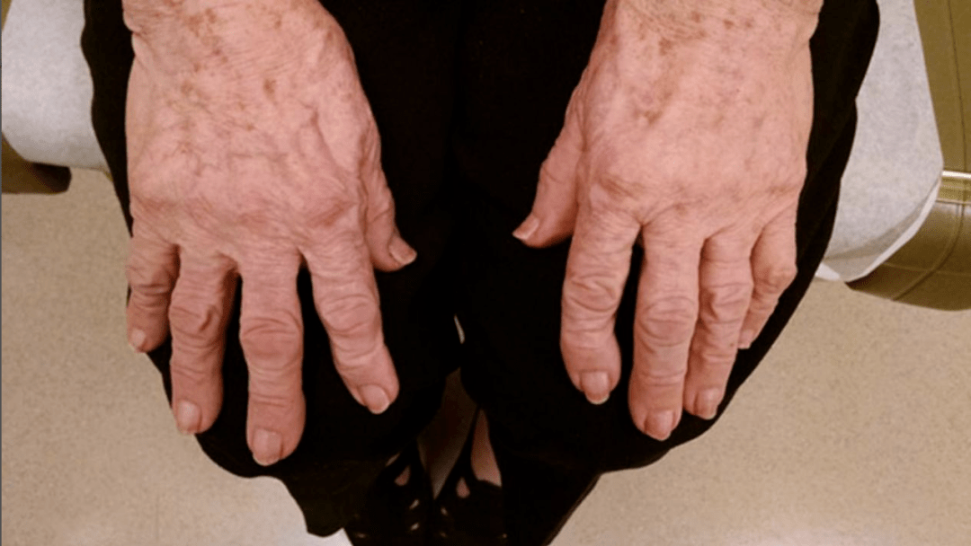 脱水10 kg,仍反复呼吸困难,原来是忽略了这个细节!_患者_治疗_症状