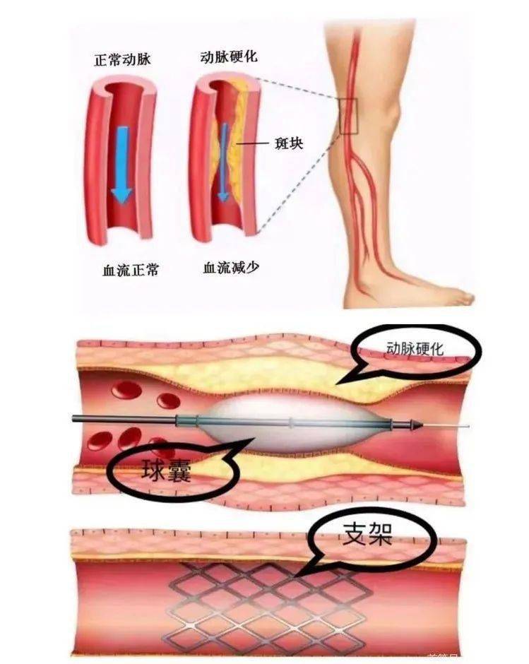 微创治疗八旬老人下肢动脉硬化闭塞症