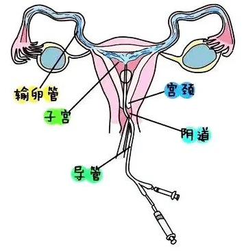 输卵管固定装置图片