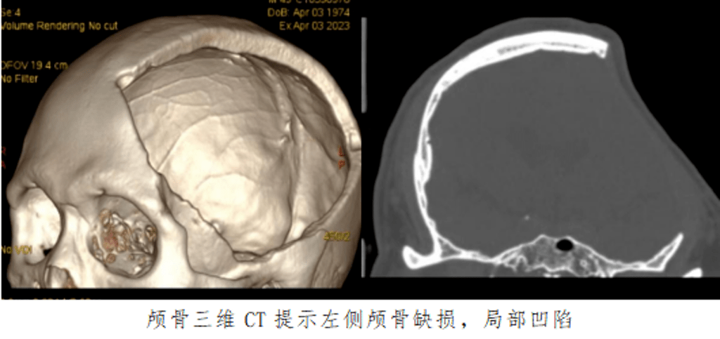自体颅骨修补术,古人医神经外科团队为重型颅脑损伤,脑疝患者补全"