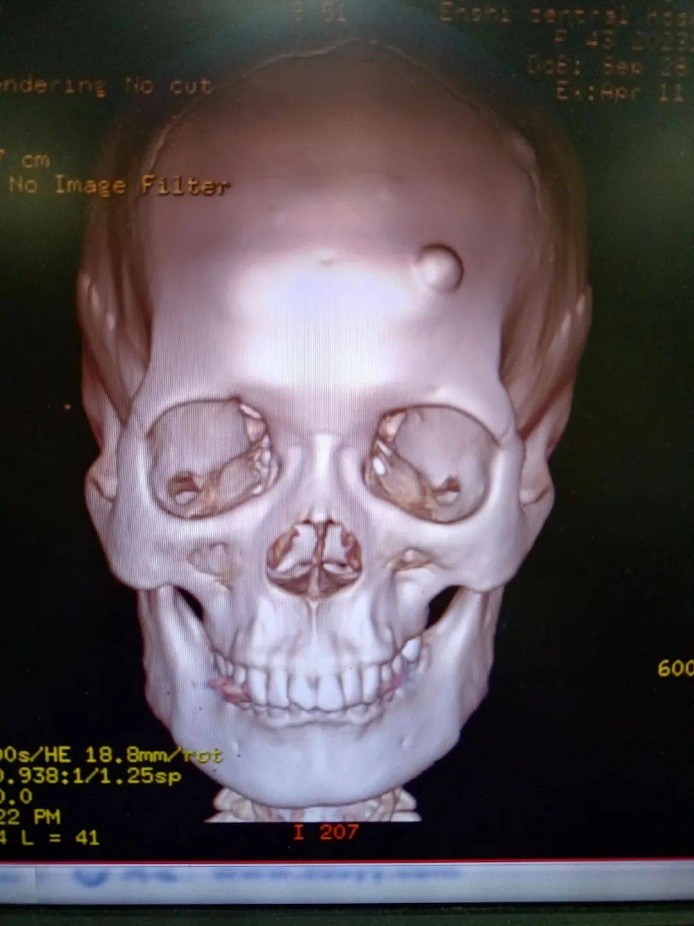 前额骨骨瘤图片图片