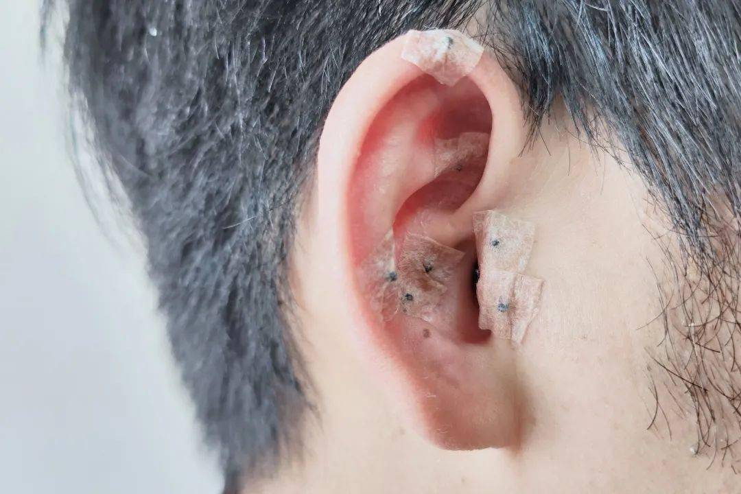 耳穴压丸之咳嗽治疗篇_耳甲_耳轮_进行