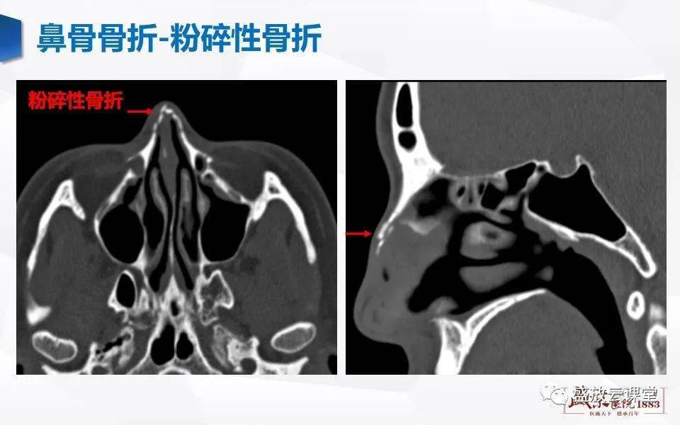 正常人鼻骨ct图图片