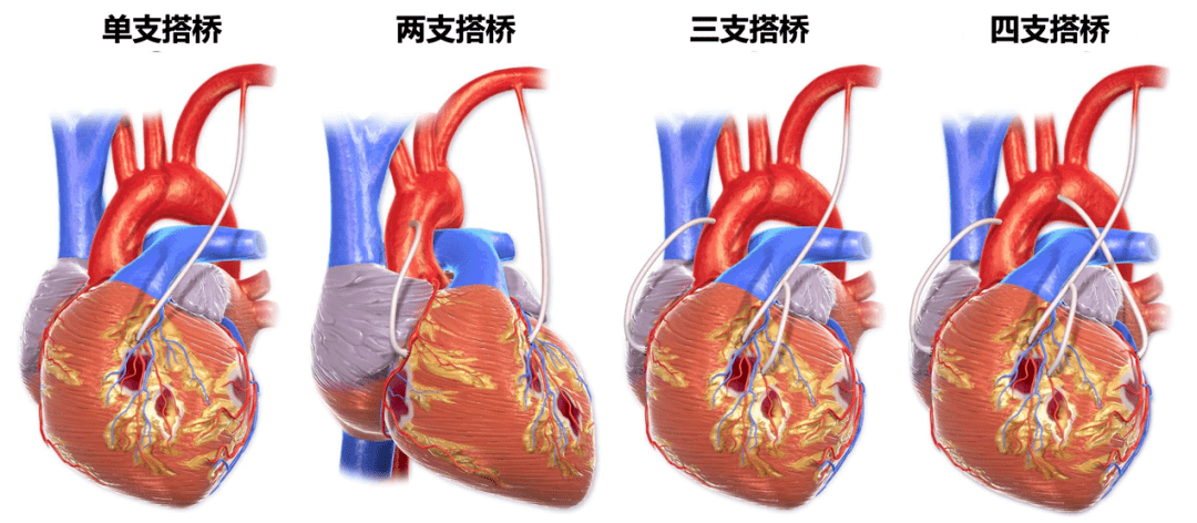 心脏搭桥手术过程图片