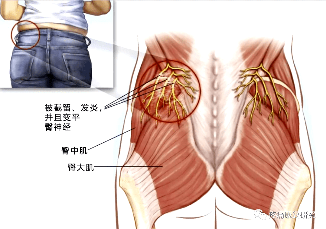 腰臀部疼痛易忽視病因:胸腰椎結合部綜合徵_神經_大腿_症狀