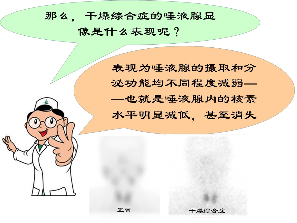 核医学唾液腺显像图片