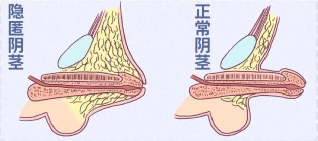 1,体型肥胖;2,阴茎外观短小;3,阴茎体发育正常;4,用手向后推送阴茎根