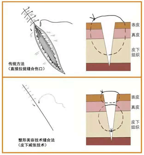 缝合方法图片