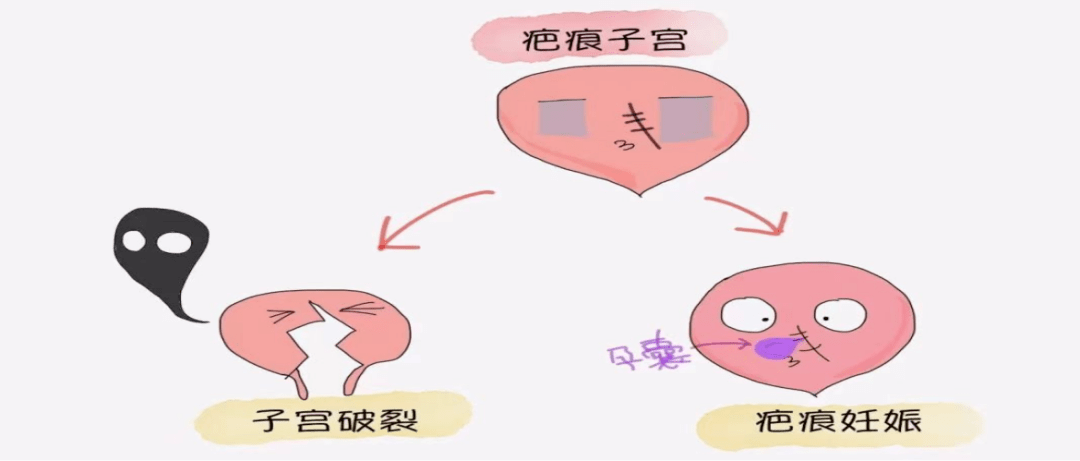 疤痕子宫图片大全图片