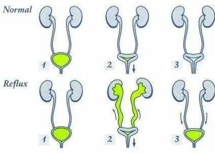 ◥上面,我们提到了泌尿道感染是引起小儿反复发热的