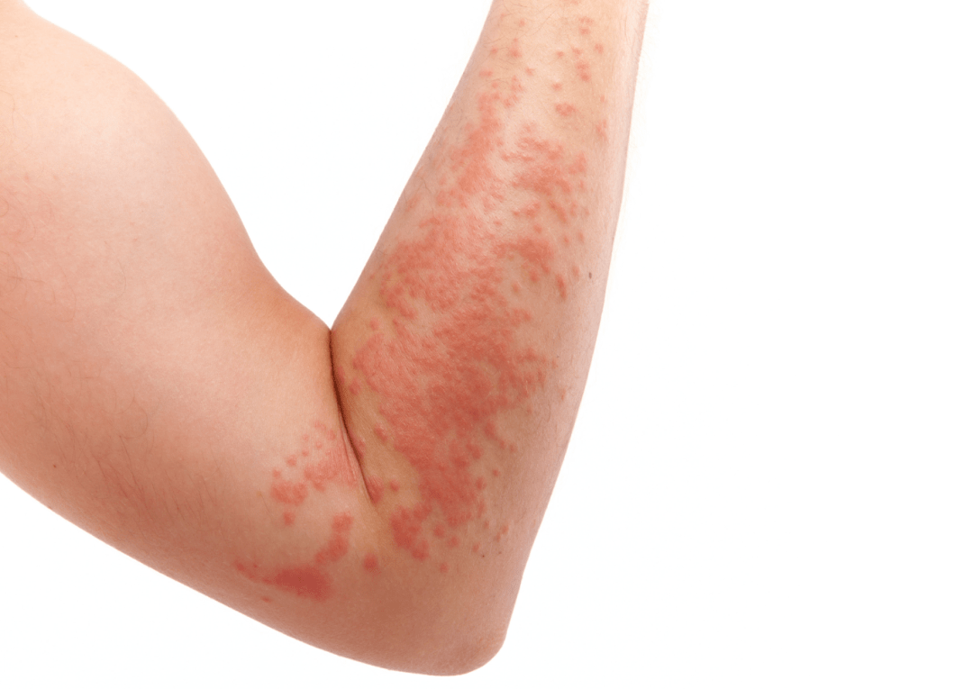 医生提醒:要改善体质,消除过敏的"土壤"!_过敏性_疾病_诊疗