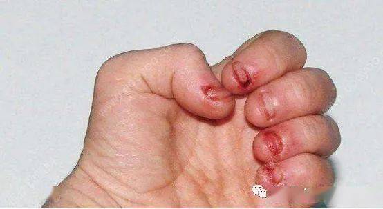 招飞体检咬手指可以服用专注达治疗吗?_指甲_儿童_行为