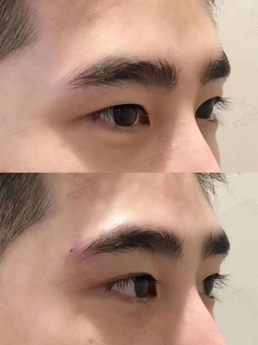 效果,一步到位9899除此之外,还有prp血清生发,丰唇,眼下填充,线雕