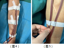 静脉输液胶布固定步骤图片