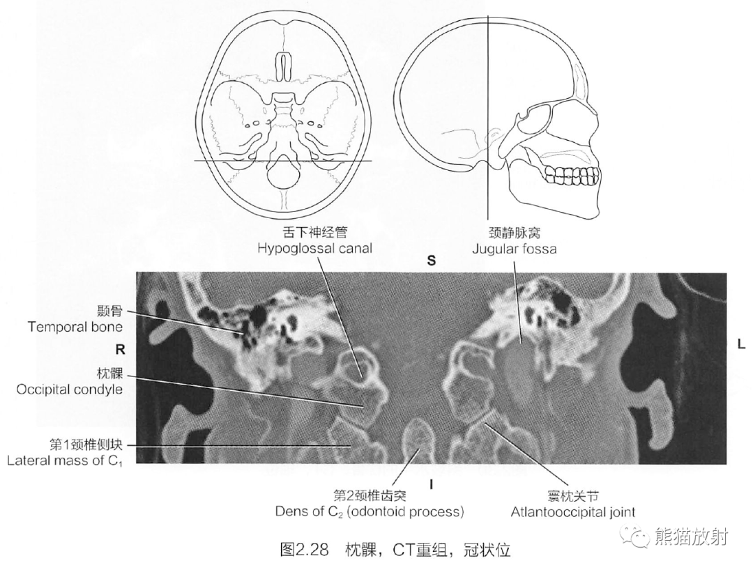 蝶骨卵圆孔图片