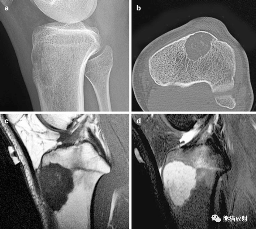 骨肿瘤病例丨软骨母细胞瘤~_诊断_病变_faint