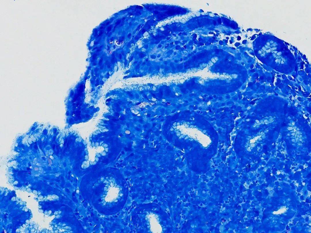 (特殊染色后显微镜下的短杆状幽门螺旋菌)抵御胃病,专家让背出以下四