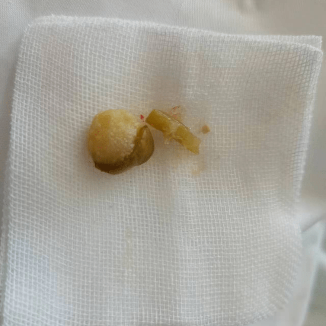 西青医院呼吸与危重症医学科与多科室协作救治一例难治性气道内异物