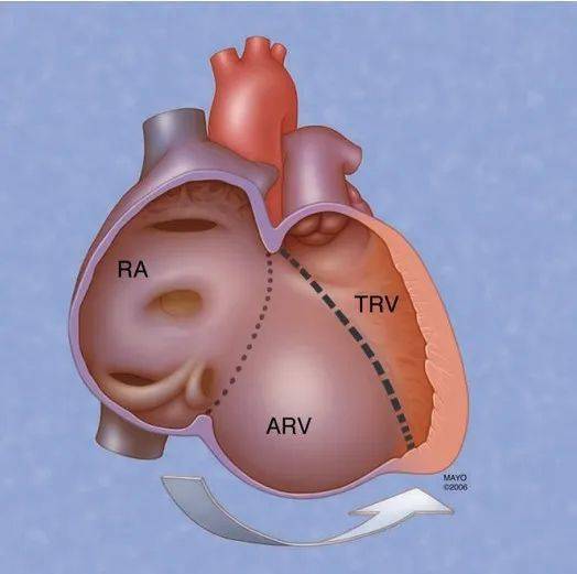 ③右心房扩大:右心房和房化右室构成较大的心腔,其内径取决于三尖瓣的