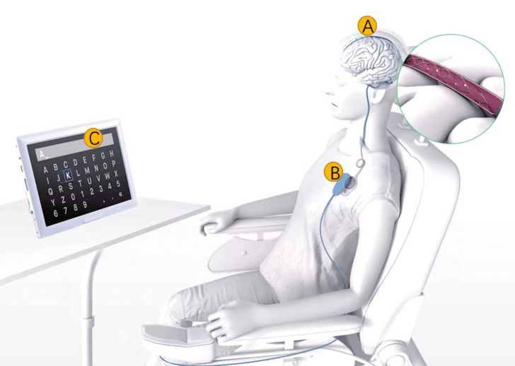 1植入式脑机接口医疗器械的系统构成