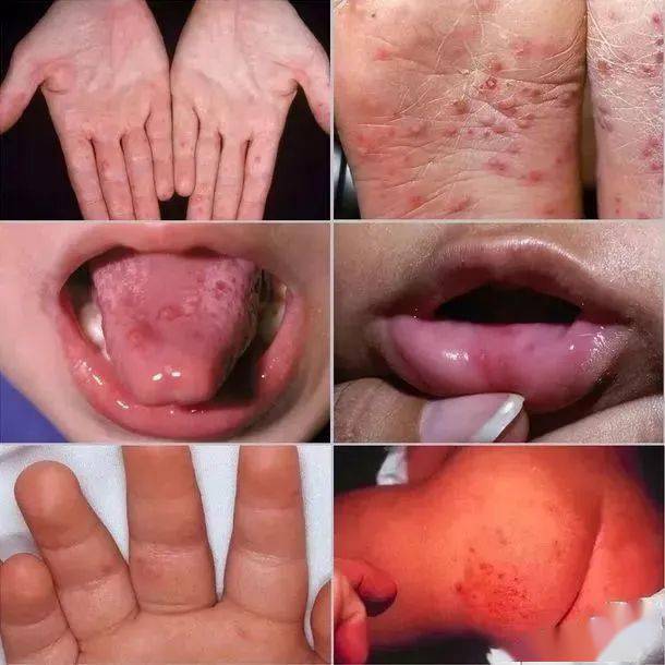 手足口病多数症状较轻,临床表现为:急性发病,口周或口腔内出现疱疹或
