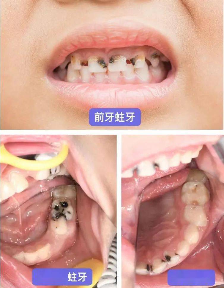 說到現在孩子牙齒問題挺多的,不是脫礦就是齲齒,有些男友帶孩子補牙