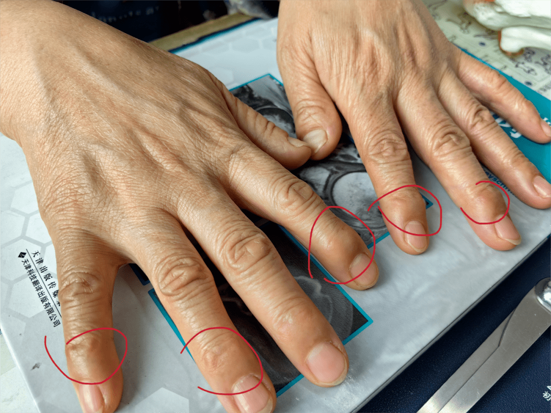 作者供图这种情况叫"赫伯登结节",在女性朋友们当中非常的常见,尤其是